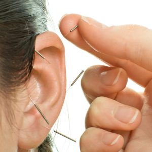 auricular acupuncture